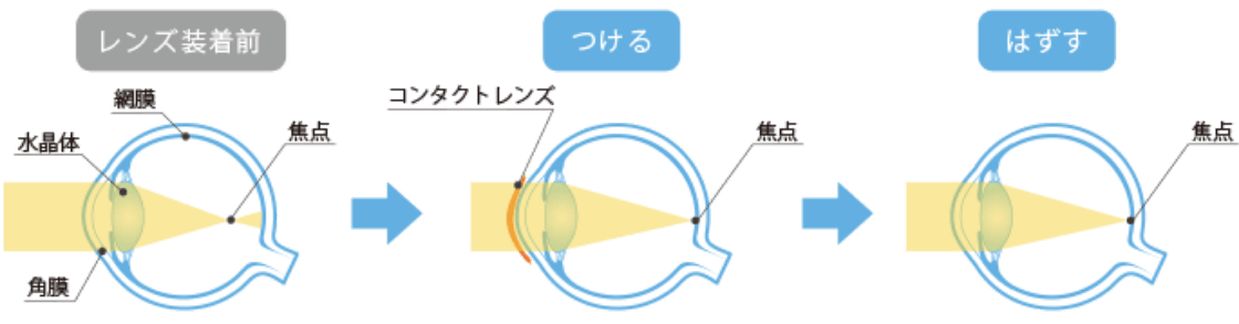 近視の視力を矯正にするには