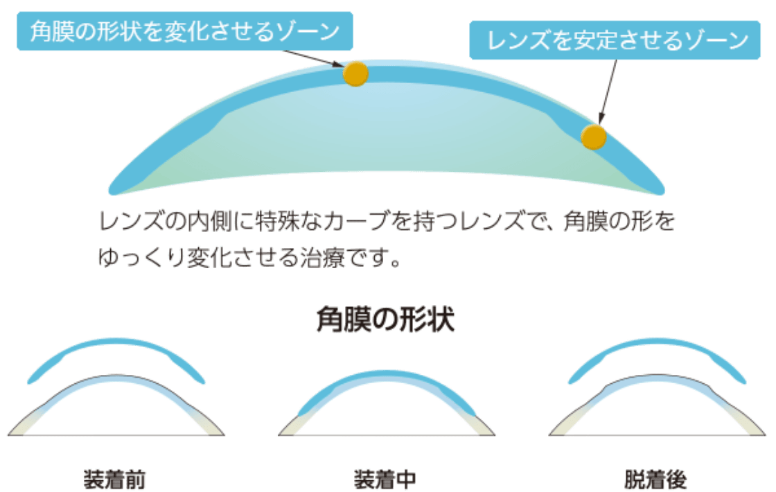 特殊なレンズデザインが角膜の形状を矯正